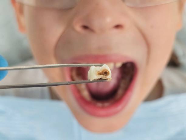 Best Emergency Tooth Extraction in Level Plains, AL
